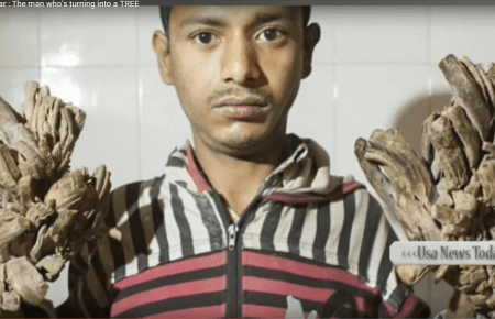 У Бангладеші прооперують «чоловіка-дерево», він потерпає від рідкісної недуги