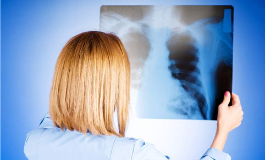 Як лікувати пневмонію і скільки це коштує?