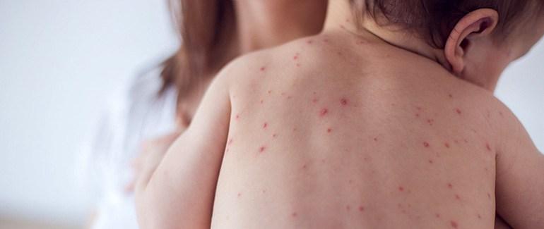 У Запорізькій області захворіли на кір ще 15 людей