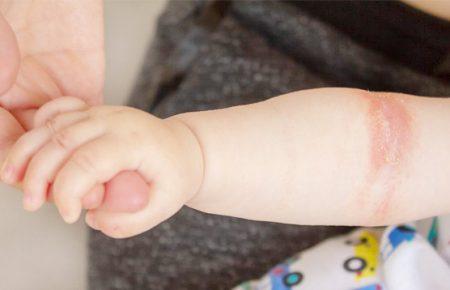 Не варто саджати маму на дієту, якщо у малюка атопічний дерматит — педіатриня
