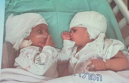 В Ізраїлі успішно роз'єднали сіамських близнючок, з'єднаних у потилиці