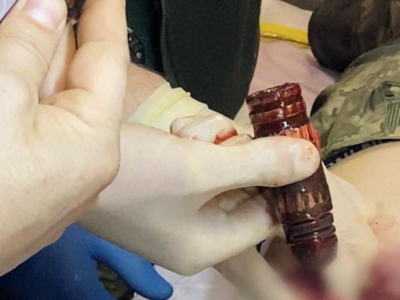 Хірурги успішно вилучили бойову частину гранати з тіла військового