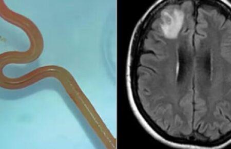 Науковці вперше у світі знайшли в мозку людини живого хробака