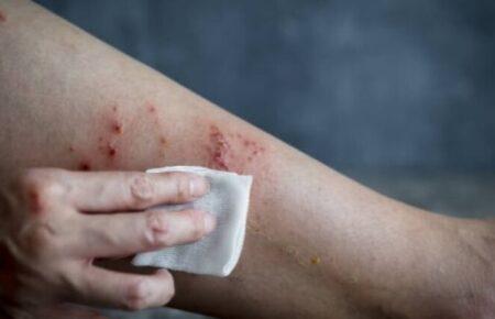 Нових випадків мавпячої віспи в Україні не фіксують — головний санлікар