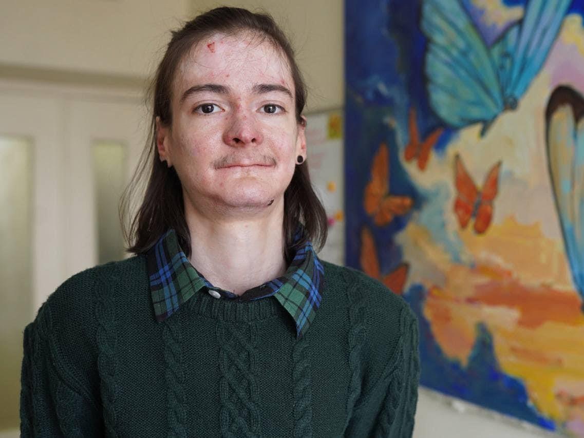 Бульозний епідермоліз: що це за захворювання, та як з ним живуть